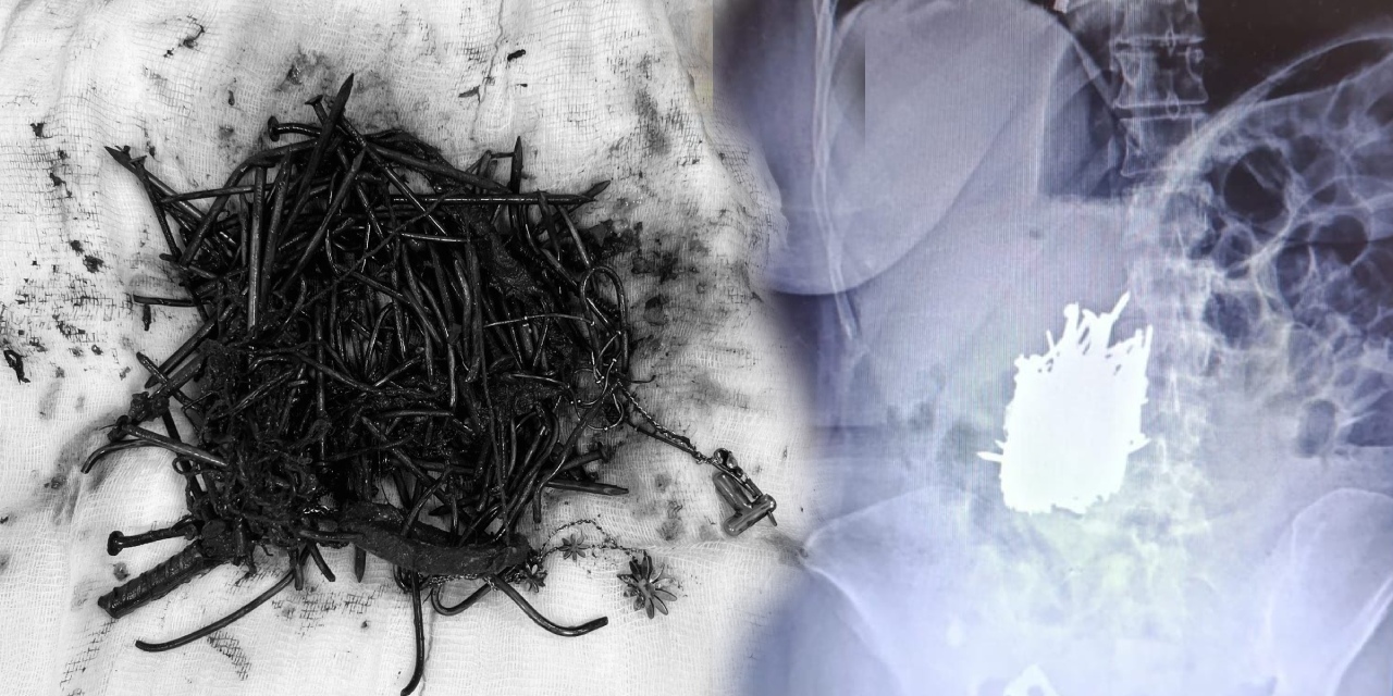 Midesinden 1 kilo metal cisim çıktı
