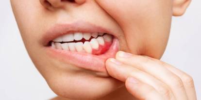 C vitamini eksikliğine dikkat: Diş eti kanamalarına yol açabilir